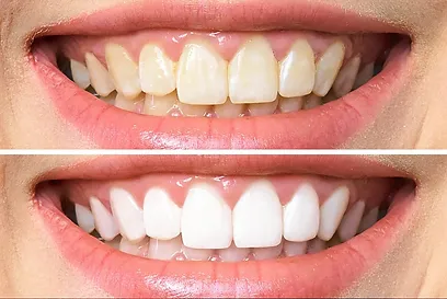 teeth-whitening gallery